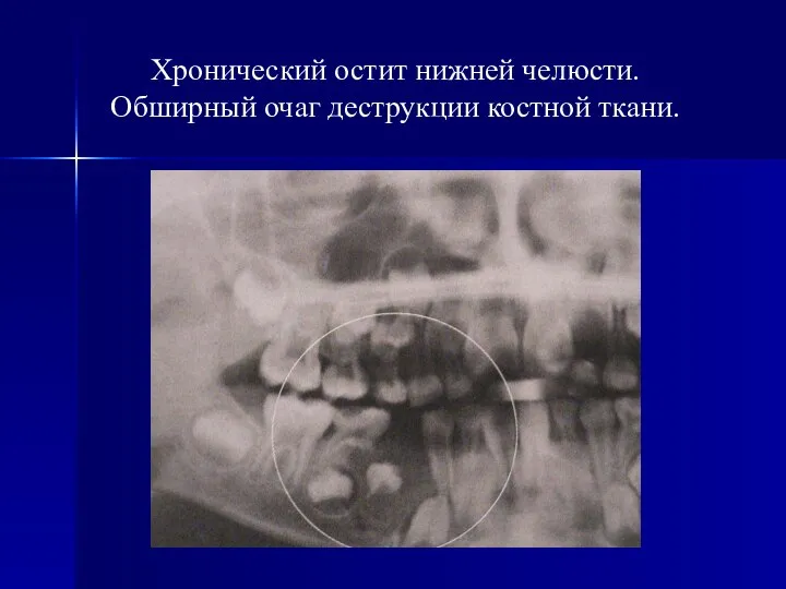 Хронический остит нижней челюсти. Обширный очаг деструкции костной ткани.