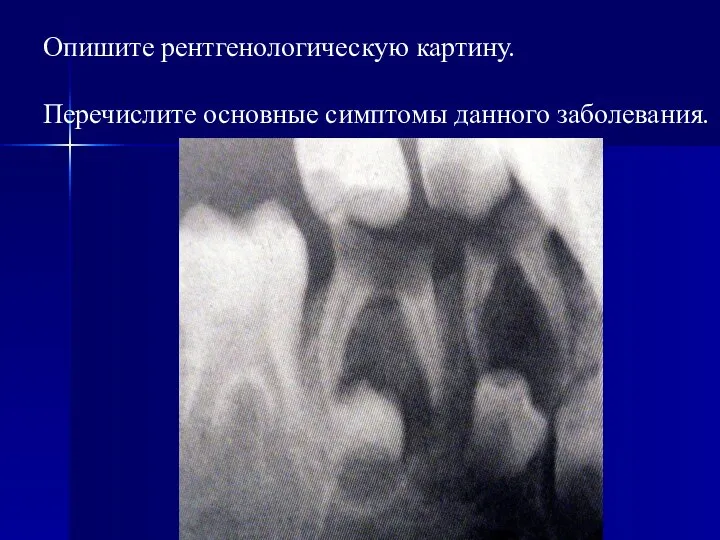 Опишите рентгенологическую картину. Перечислите основные симптомы данного заболевания.