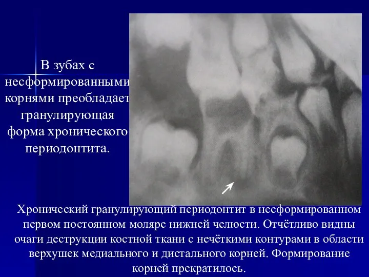 В зубах с несформированными корнями преобладает гранулирующая форма хронического периодонтита. Хронический
