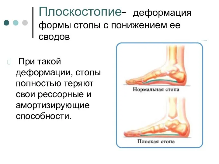 Плоскостопие- деформация формы стопы с понижением ее сводов При такой деформации,