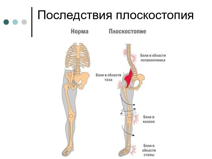 Последствия плоскостопия