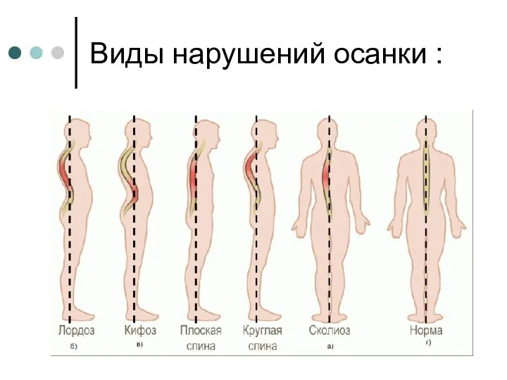 Виды нарушений осанки :