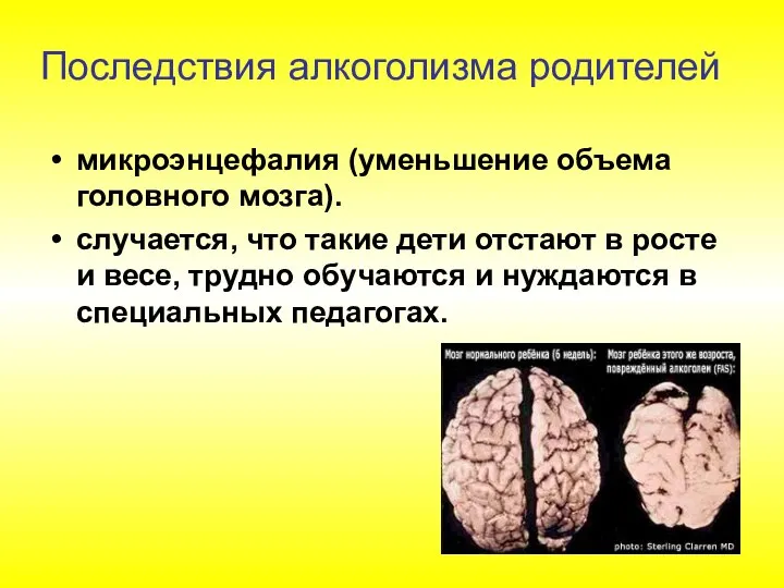 микроэнцефалия (уменьшение объема головного мозга). случается, что такие дети отстают в