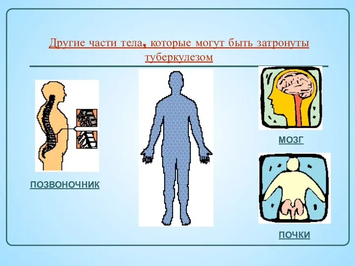 Другие части тела, которые могут быть затронуты туберкулезом ПОЗВОНОЧНИК МОЗГ ПОЧКИ