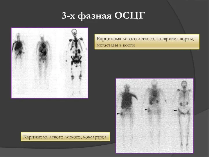 3-х фазная ОСЦГ Карцинома левого легкого, аневризма аорты, метастазы в кости Карцинома левого легкого, коксартроз