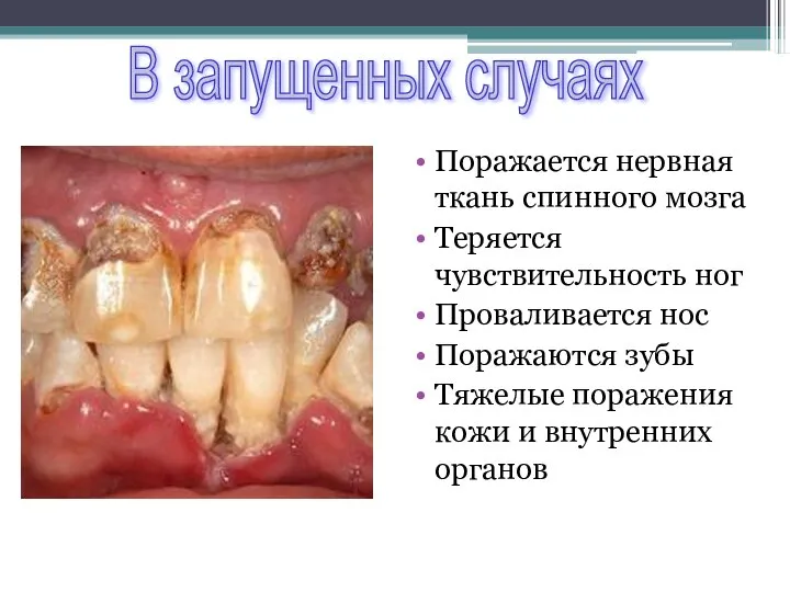 Поражается нервная ткань спинного мозга Теряется чувствительность ног Проваливается нос Поражаются