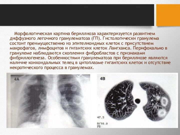 Морфологическая картина бериллиоза характеризуется развитием диффузного легочного гранулематоза (ГП). Гистологически гранулема