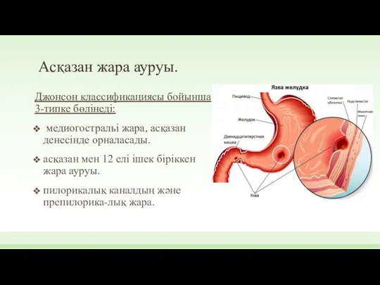 Асқазан жара ауруы. Джонсон классификациясы бойынша 3-типке бөлінеді: медиогостральі жара, асқазан