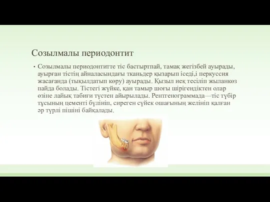 Созылмалы периодонтит Созылмалы периодонтитте тіс бастыртпай, тамақ жегізбей ауырады, ауырған тістің