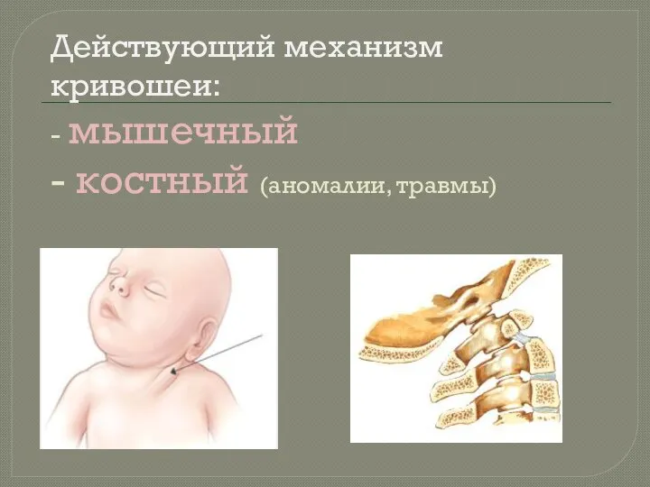 Действующий механизм кривошеи: - мышечный - костный (аномалии, травмы)