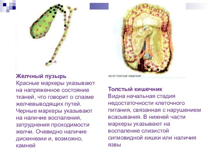 Желчный пузырь Красные маркеры указывают на напряженное состояние тканей, что говорит