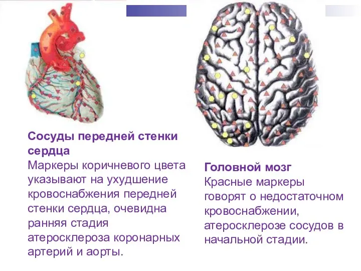 Сосуды передней стенки сердца Маркеры коричневого цвета указывают на ухудшение кровоснабжения