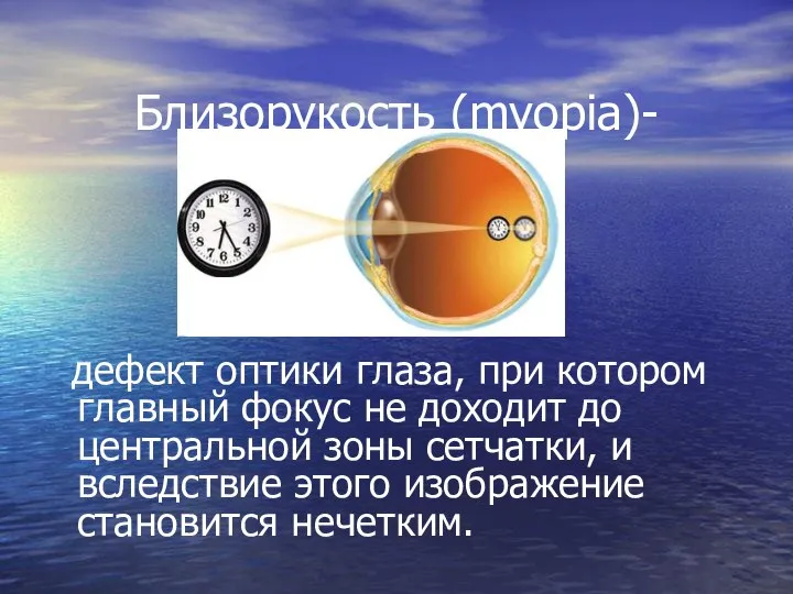 Близорукость (myopia)- дефект оптики глаза, при котором главный фокус не доходит