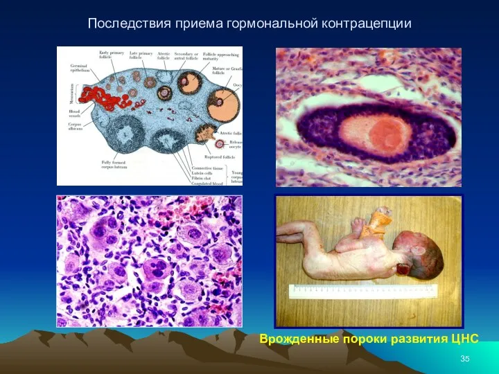 Последствия приема гормональной контрацепции Врожденные пороки развития ЦНС