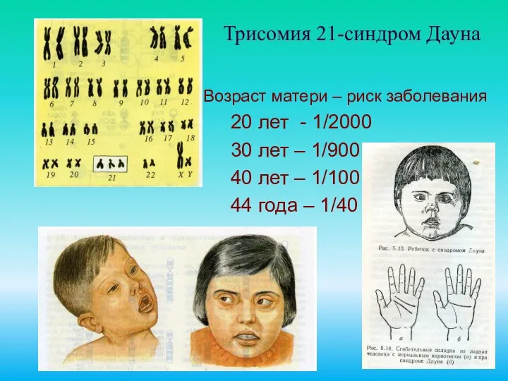 Трисомия 21-синдром Дауна Возраст матери – риск заболевания 20 лет -