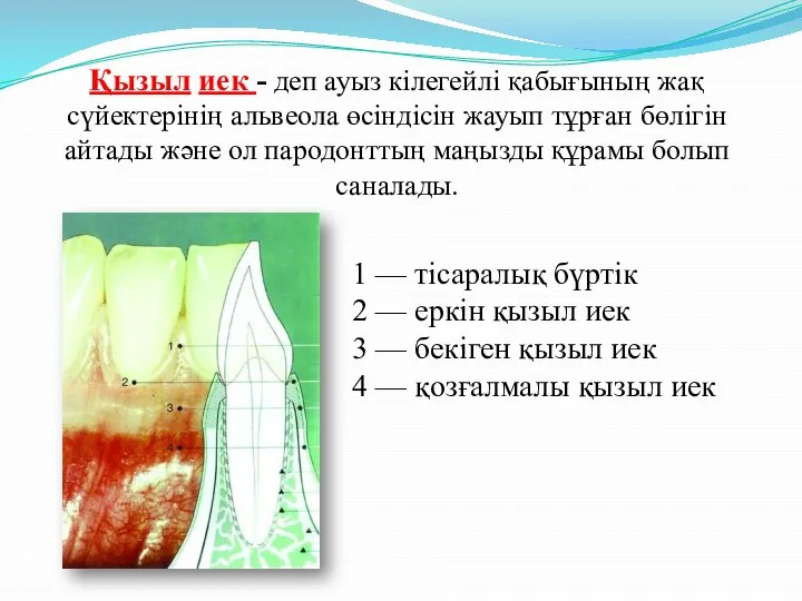 Қызыл иек - деп ауыз кілегейлі қабығының жақ сүйектерінің альвеола өсіндісін