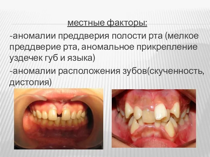 местные факторы: -аномалии преддверия полости рта (мелкое преддверие рта, аномальное при­крепление