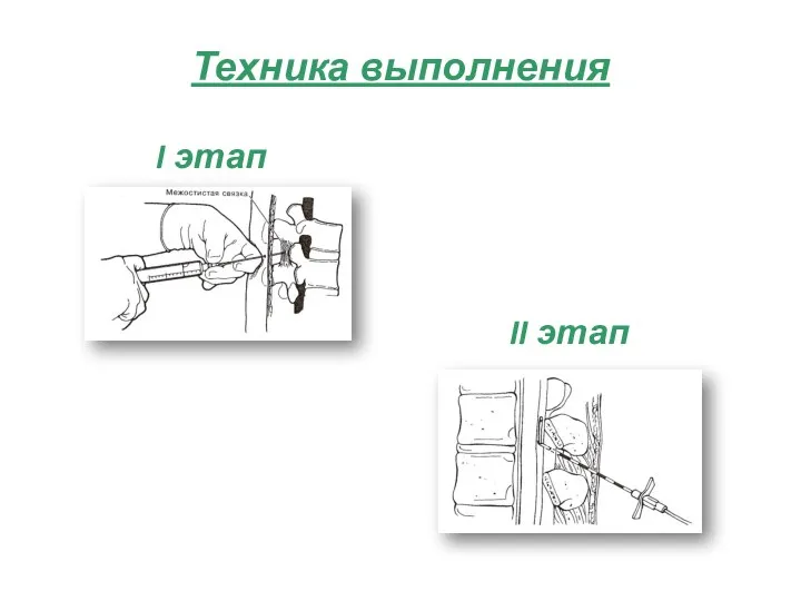 Техника выполнения I этап II этап