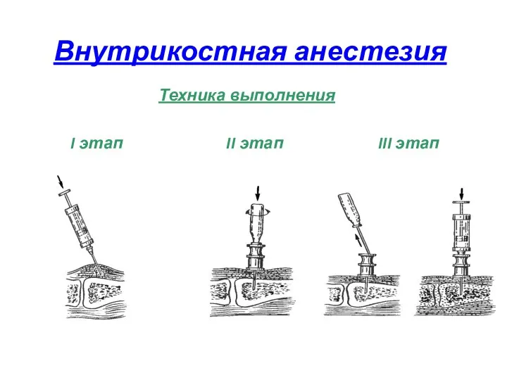 Внутрикостная анестезия Техника выполнения I этап II этап III этап