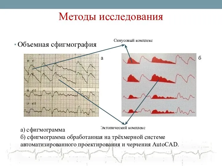 Методы исследования Объемная сфигмография а б а) сфигмограмма б) сфигмограмма обработанная