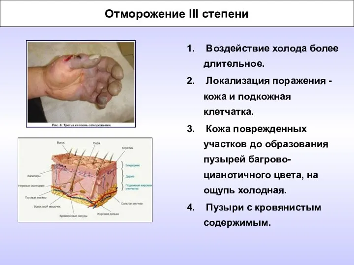 Отморожение III степени Воздействие холода более длительное. Локализация поражения - кожа