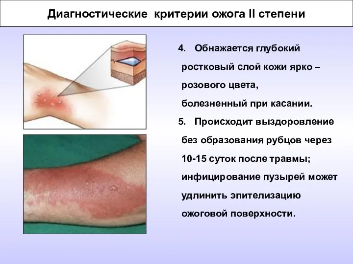 Диагностические критерии ожога II степени Обнажается глубокий ростковый слой кожи ярко