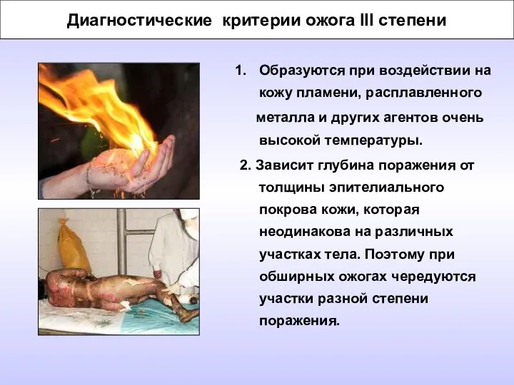 Диагностические критерии ожога III степени Образуются при воздействии на кожу пламени,