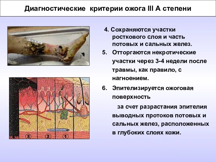 Диагностические критерии ожога III А степени 4. Сохраняются участки росткового слоя