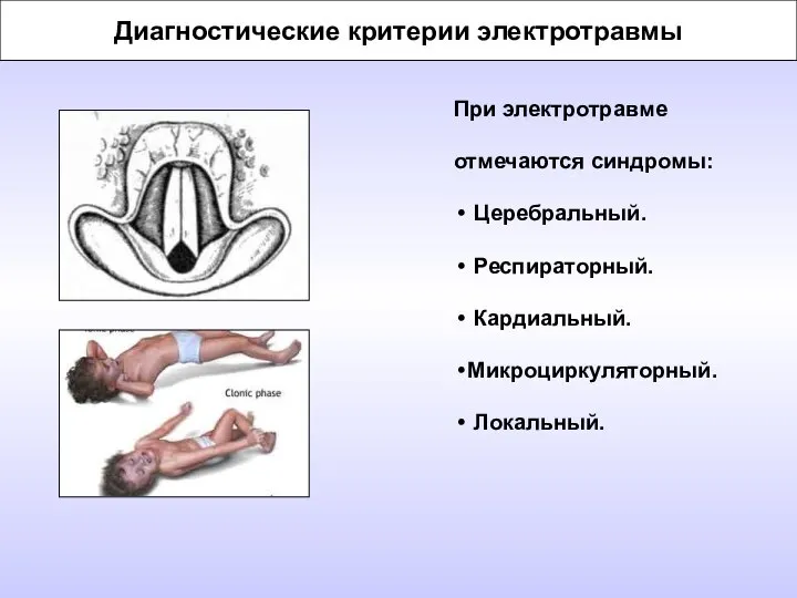 Диагностические критерии электротравмы При электротравме отмечаются синдромы: Церебральный. Респираторный. Кардиальный. Микроциркуляторный. Локальный.