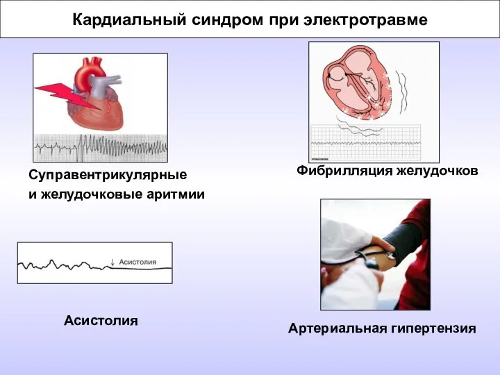 Кардиальный синдром при электротравме Суправентрикулярные и желудочковые аритмии Асистолия Фибрилляция желудочков Артериальная гипертензия