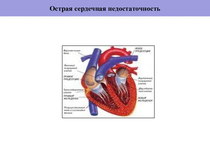 Острая сердечная недостаточность