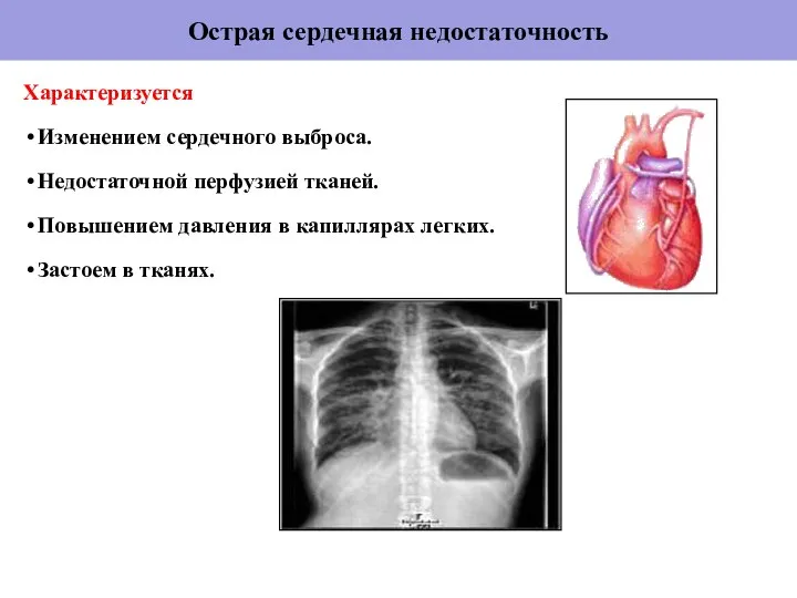 Острая сердечная недостаточность Характеризуется Изменением сердечного выброса. Недостаточной перфузией тканей. Повышением