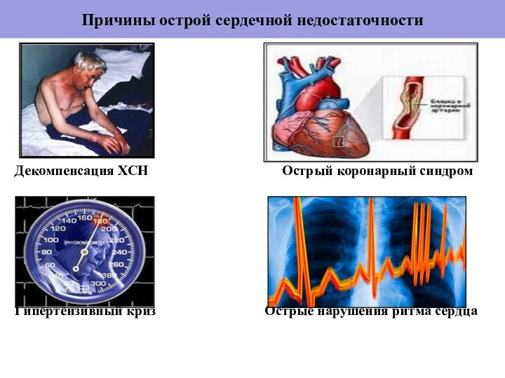 Причины острой сердечной недостаточности Декомпенсация ХСН Острый коронарный синдром Гипертензивный криз Острые нарушения ритма сердца