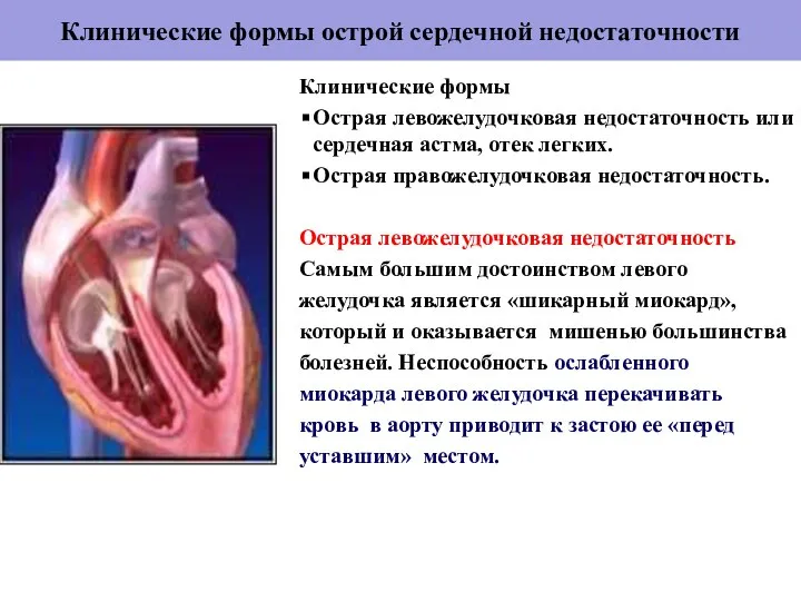 Клинические формы острой сердечной недостаточности Клинические формы Острая левожелудочковая недостаточность или