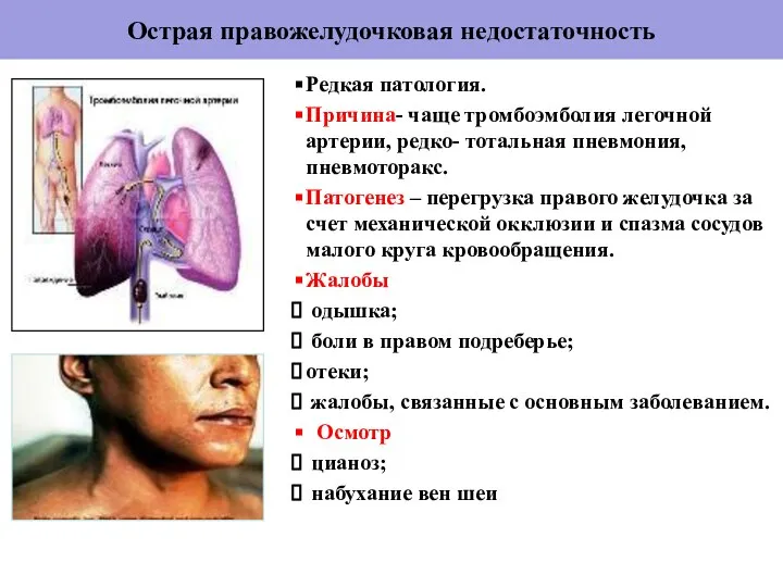 Острая правожелудочковая недостаточность Редкая патология. Причина- чаще тромбоэмболия легочной артерии, редко-