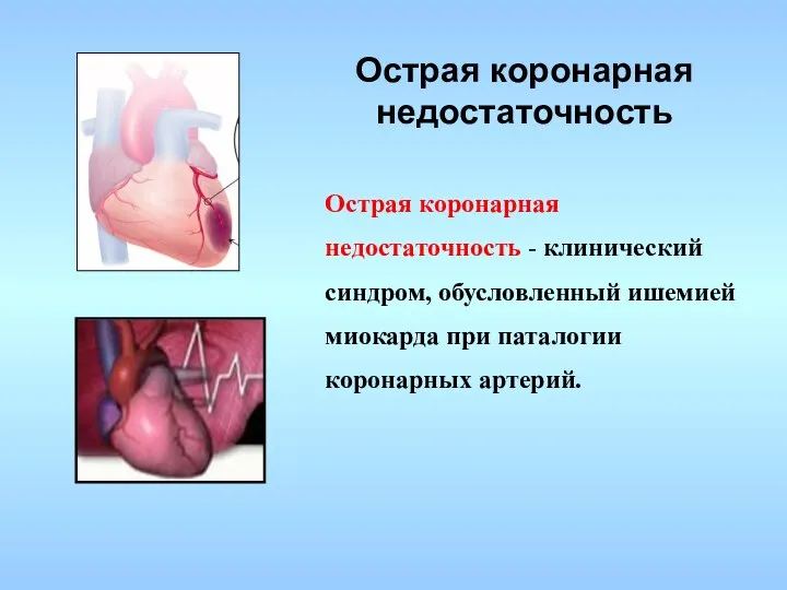 Острая коронарная недостаточность Острая коронарная недостаточность - клинический синдром, обусловленный ишемией миокарда при паталогии коронарных артерий.