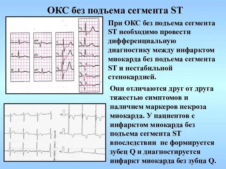 ОКС без подъема сегмента ST При ОКС без подъема сегмента ST