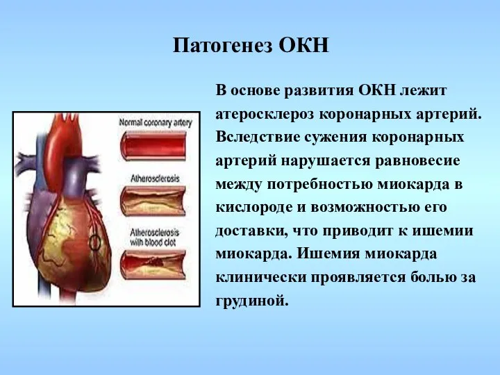 Патогенез ОКН В основе развития ОКН лежит атеросклероз коронарных артерий. Вследствие