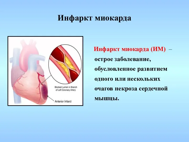 Инфаркт миокарда Инфаркт миокарда (ИМ) – острое заболевание, обусловленное развитием одного