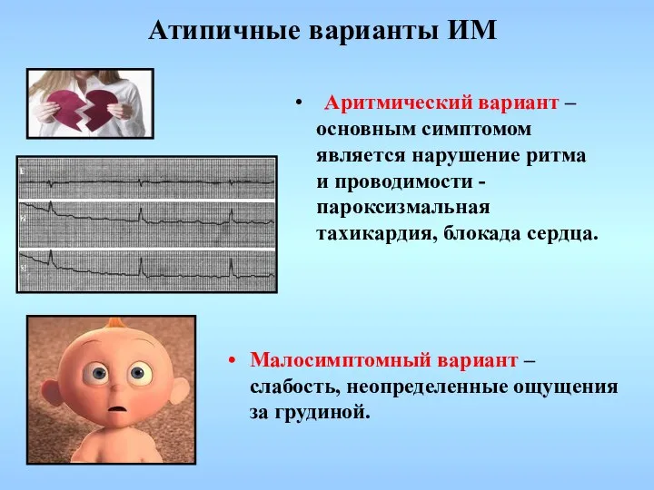 Атипичные варианты ИМ Аритмический вариант – основным симптомом является нарушение ритма