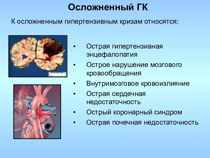 Острая гипертензивная энцефалопатия Острое нарушение мозгового кровообращения Внутримозговое кровоизлияние Острая сердечная