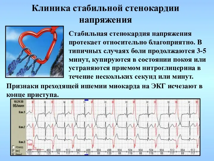 Клиника стабильной стенокардии напряжения Стабильная стенокардия напряжения протекает относительно благоприятно. В