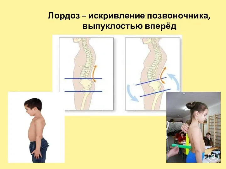 Лордоз – искривление позвоночника, выпуклостью вперёд