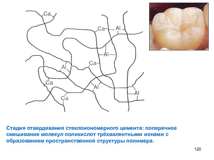 Стадия отвердевания стеклоиономерного цемента: поперечное смешивание молекул поликислот трёхвалентными ионами с образованием пространственной структуры полимера.