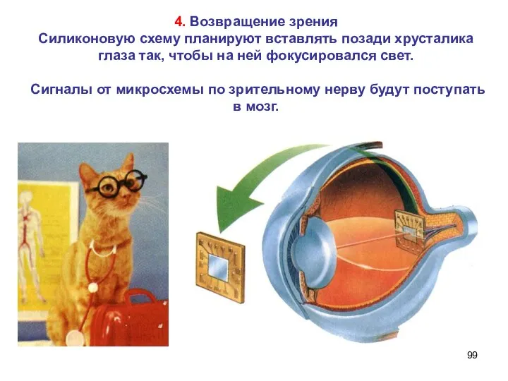 4. Возвращение зрения Силиконовую схему планируют вставлять позади хрусталика глаза так,