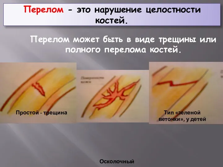 Перелом - это нарушение целостности костей. Перелом может быть в виде