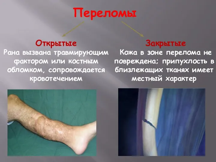 Открытые Рана вызвана травмирующим фактором или костным обломком, сопровождается кровотечением Закрытые