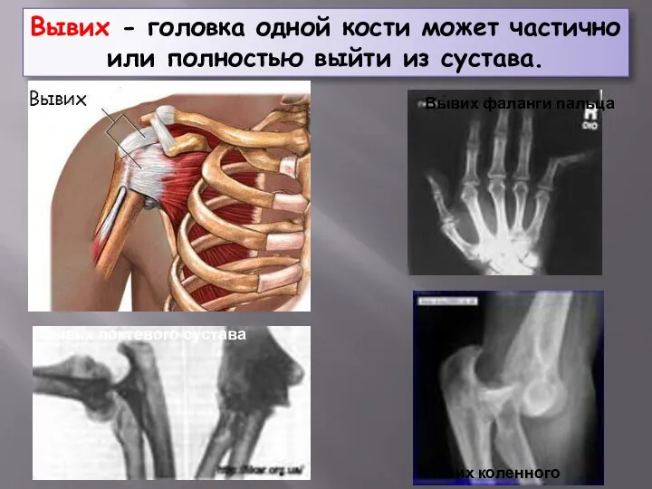 Вывих - головка одной кости может частично или полностью выйти из