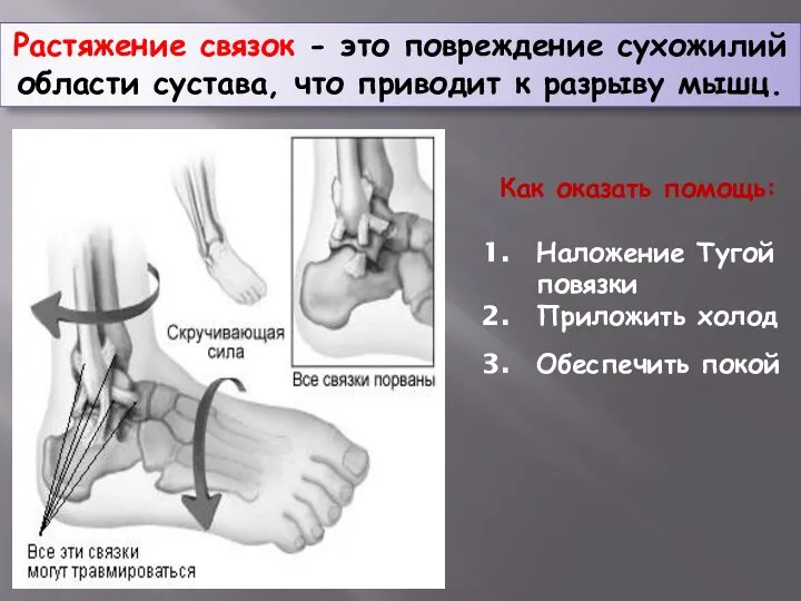 Растяжение связок - это повреждение сухожилий области сустава, что приводит к