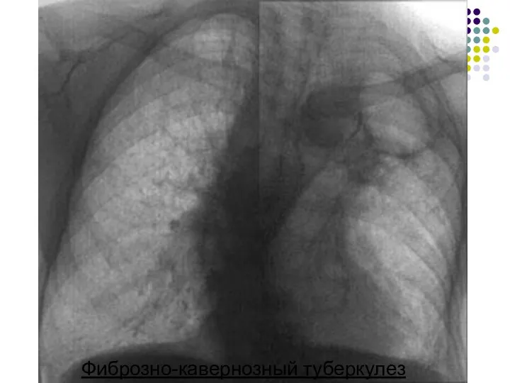 Фиброзно-кавернозный туберкулез